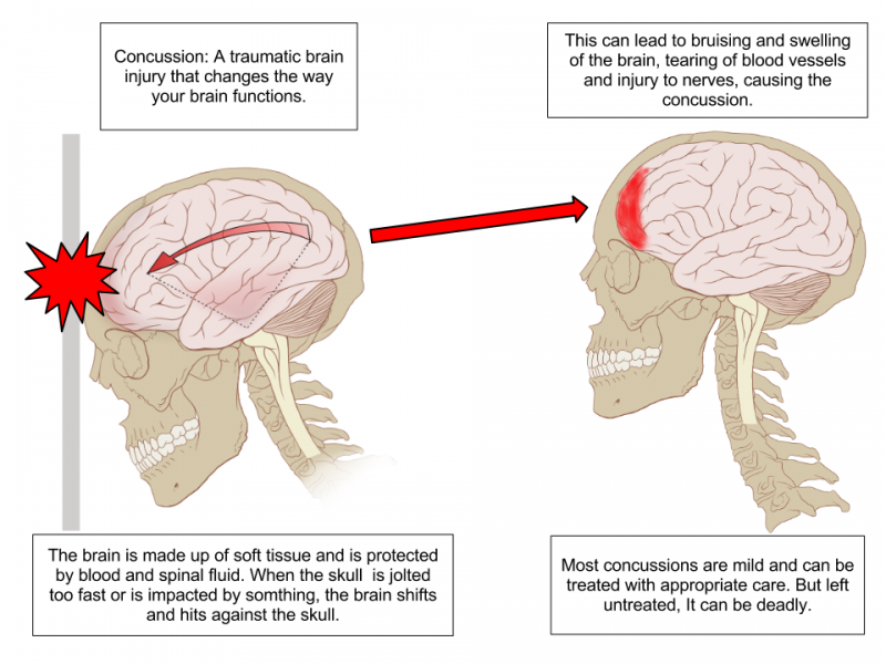 Brain After Concussion Cobbers On The Brain