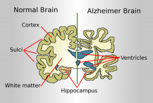 This image shows the degradation of the brain when affected with Alzheimer's disease.