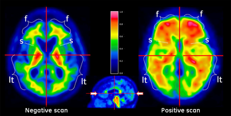 The Brain And Ptsd Cobbers On The Brain