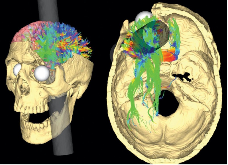 concussion-behavioral-changes-cobbers-on-the-brain