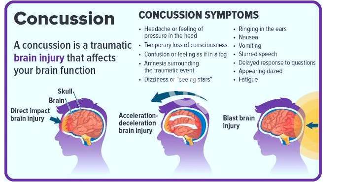 can-you-sleep-after-getting-a-concussion-cobbers-on-the-brain